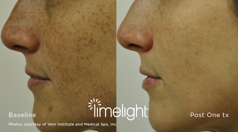 Cutera Limelight Before And After