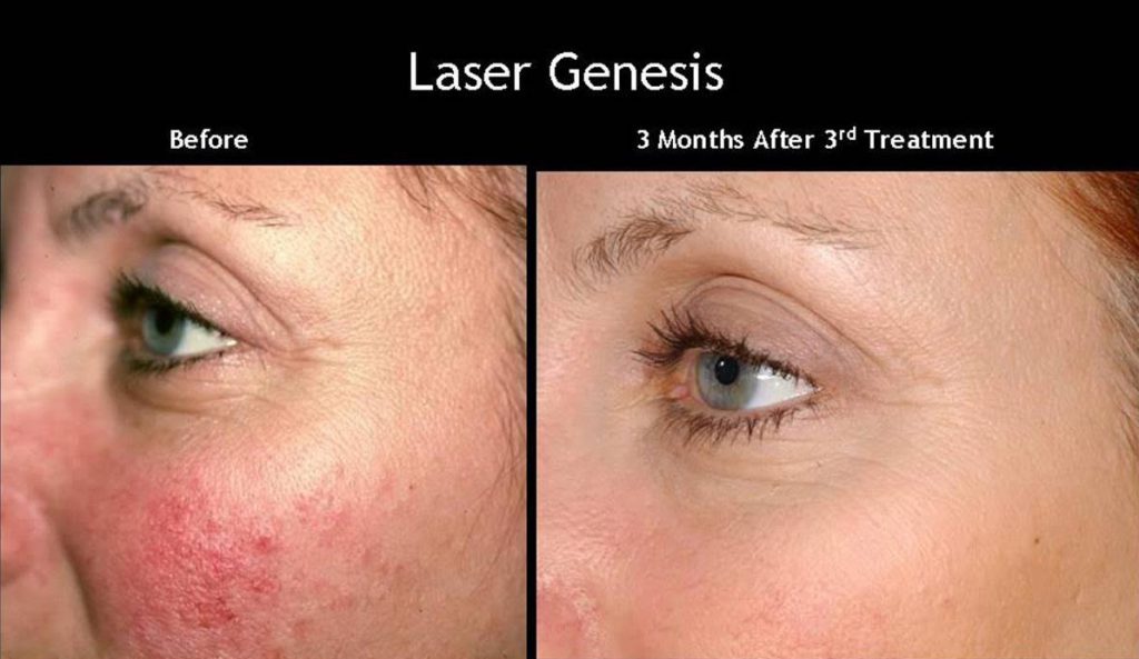 CUTERA Laser Genesis Treatment In Midtown Toronto Midtown Med Spa 