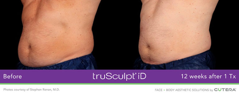 Trusculpt® Flex Id For Men Body Contouring Midtown Med Spa Toronto