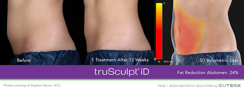 truSculpt® flex iD for Men Body Contouring