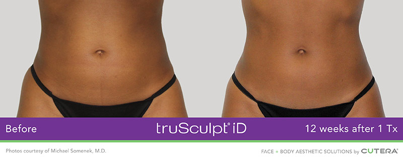 truSculpt® iD Non-Surgical Body Conturing